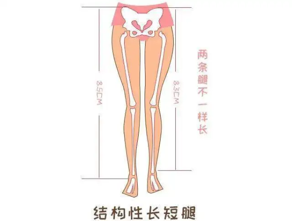 结构性长短腿