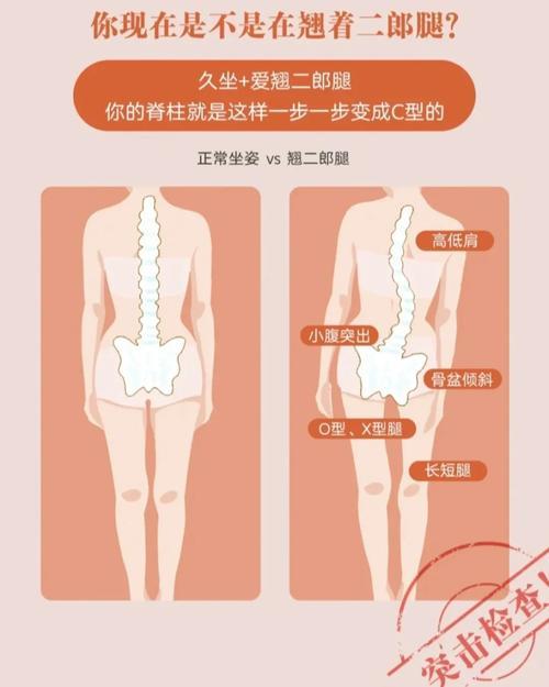 骨盆倾斜脊柱侧弯