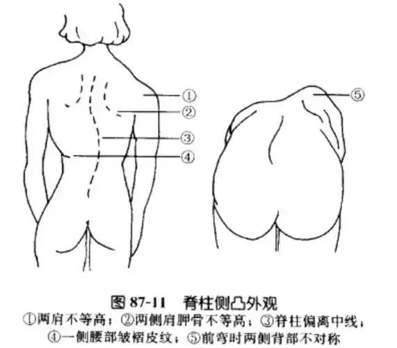 脊柱侧弯外观特征