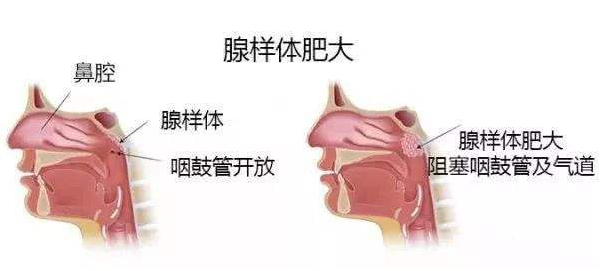 原来娃的颜值杀手是它腺样体肥大