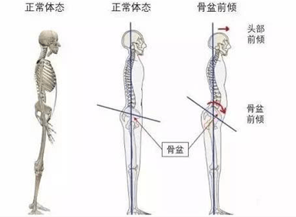 儿童骨盆前倾如何矫正?