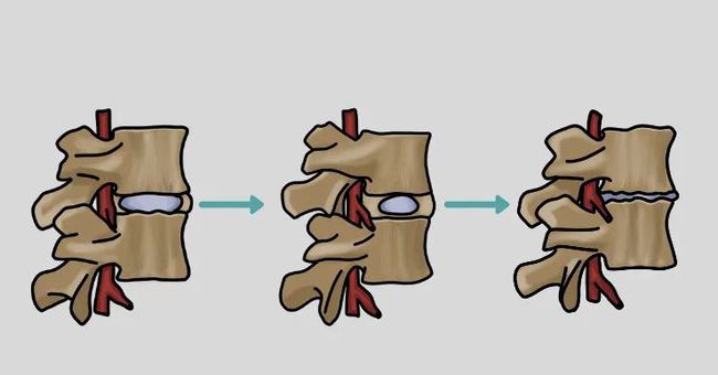 預防腰椎滑脫從日常生活做起-【直樂】石家莊脊柱側彎醫院_治療椎間盤