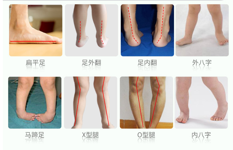 足腿部畸形