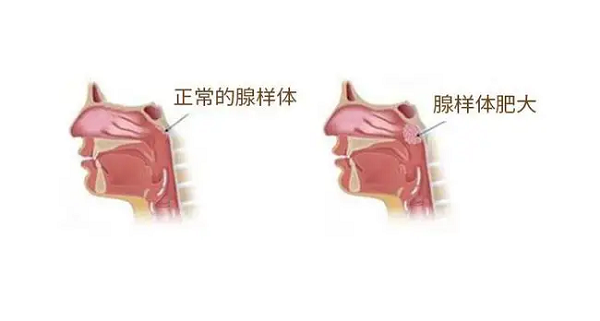 腺样体对比图