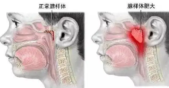 腺样体对比图