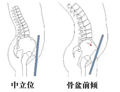 骨盆前倾