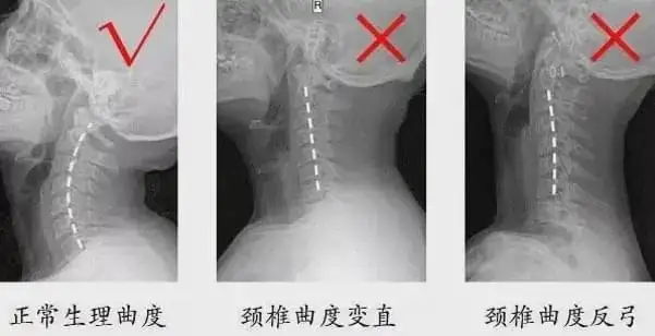 颈椎生理曲度变直