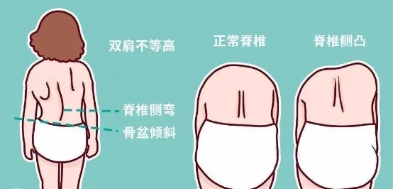脊柱侧弯