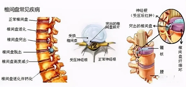 椎间盘疾病