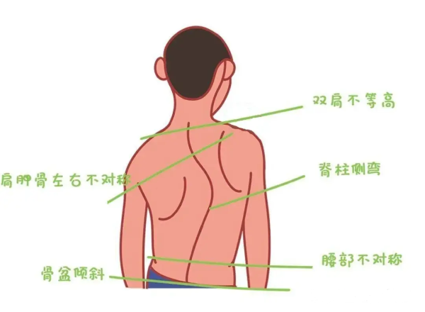 小孩脊椎骨突出怎么办图片