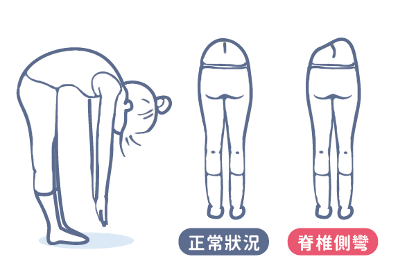 脊柱侧弯自测