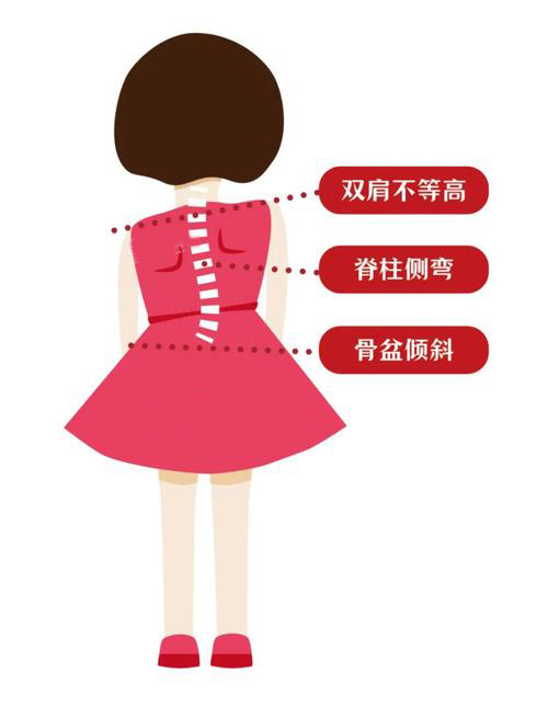 脊柱侧弯