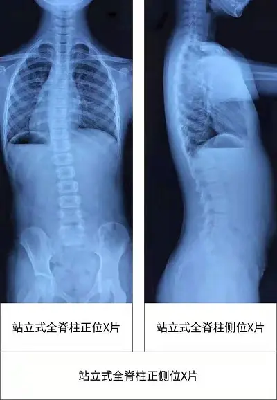 全脊柱正侧位x光片