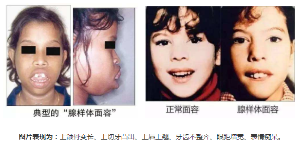正常面容与腺样体面容图片对比图