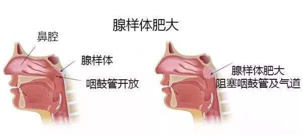腺样体肥大