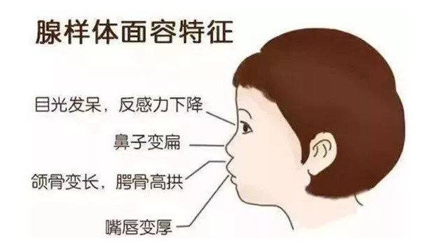 腺样体面容特征