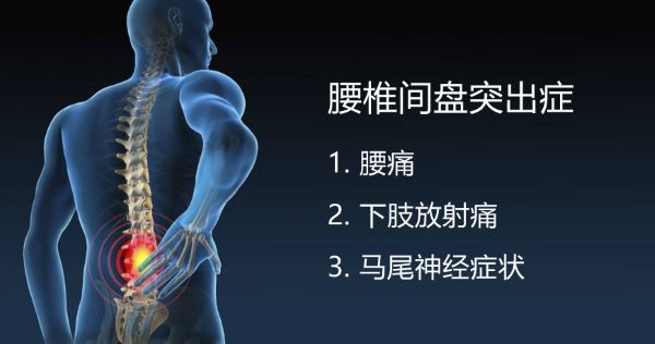 腰椎间盘突出症症状