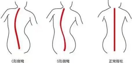 脊柱侧弯
