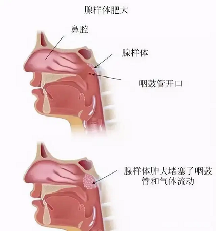 腺样体肥大