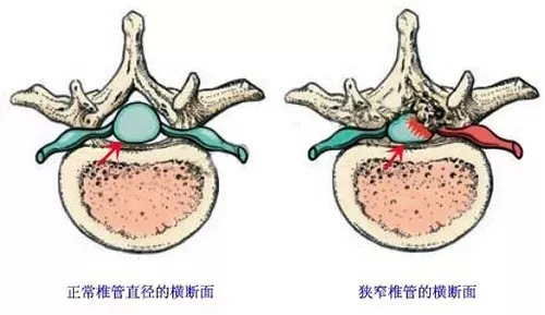 正常椎管和椎管狭窄横断面对比图