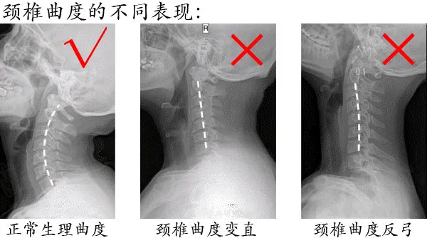 颈椎生理曲度反弓对比图片