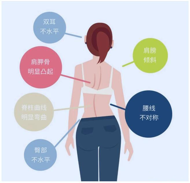 脊柱侧弯典型外观特征