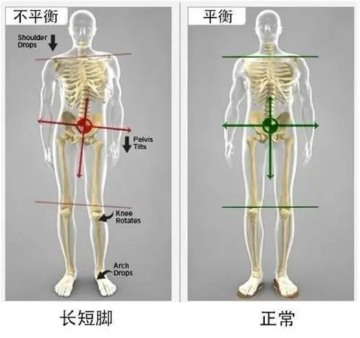 脊柱侧弯长短腿