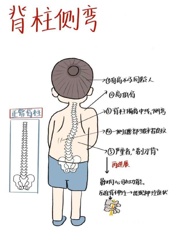 脊柱侧弯病因危害