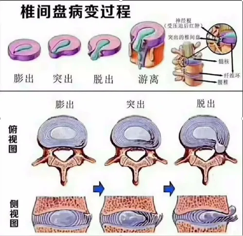 直乐大讲堂：腰椎间盘突出保守治疗还是手术？其实不难选 患者 保守 治疗 腰椎间盘突出 手术 健康界