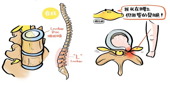 腰椎间盘突出